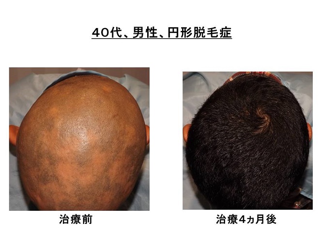 円形脱毛症　病院""